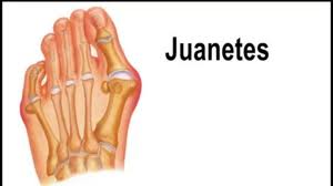 juanete