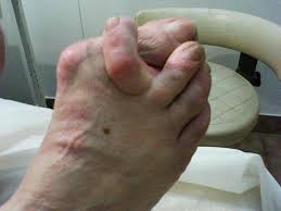 podologia geriatrica